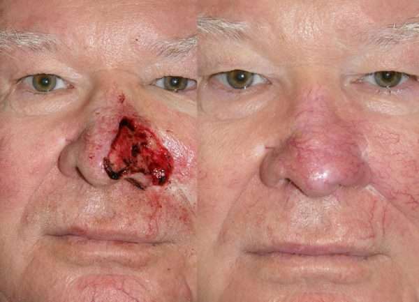 Basal Cell Carcinoma Nose Removal