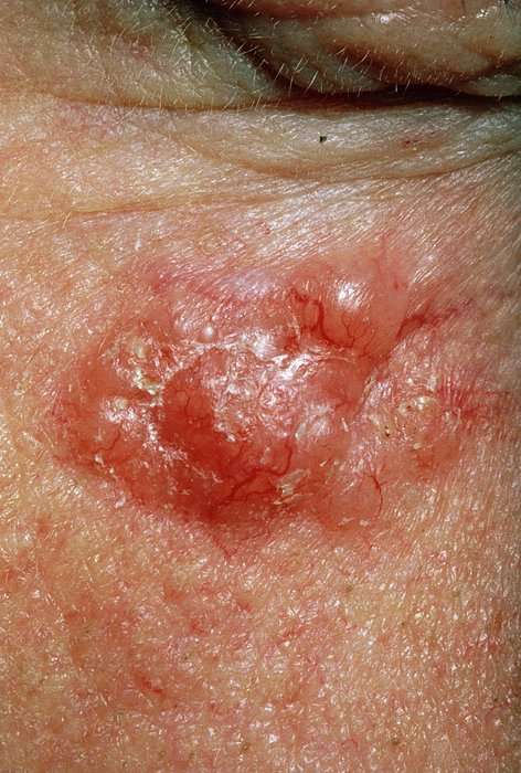 Basal Cell Carcinoma On A Patient