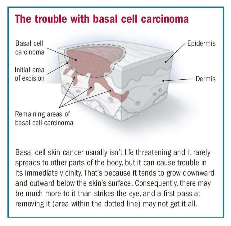 Basal cell carcinoma overview
