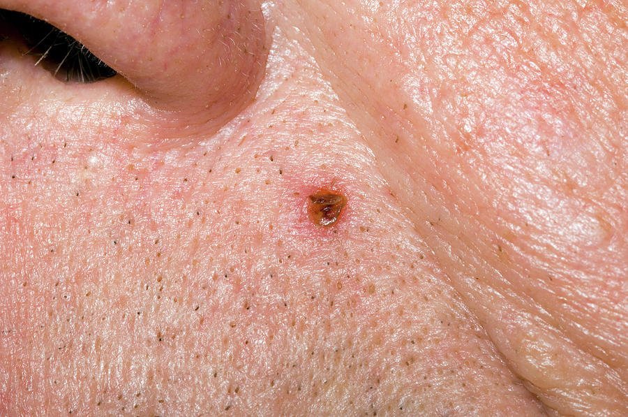 Basal Cell Carcinoma Photograph by Dr P. Marazzi/science ...