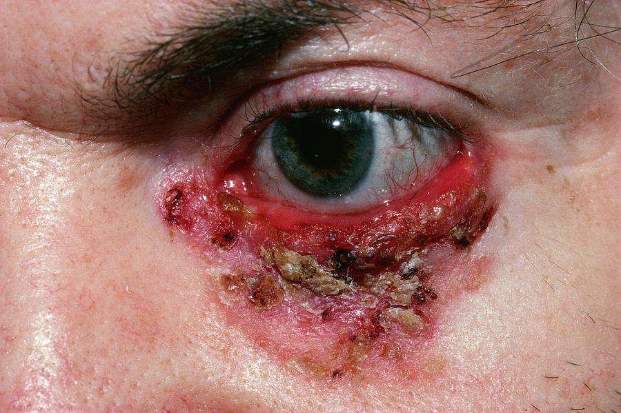 Basal Cell Carcinoma Photograph by Microscape