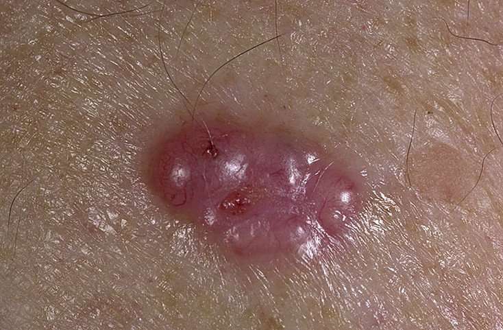 Basal Cell Carcinoma Pictures â 54 Photos &  Images ...