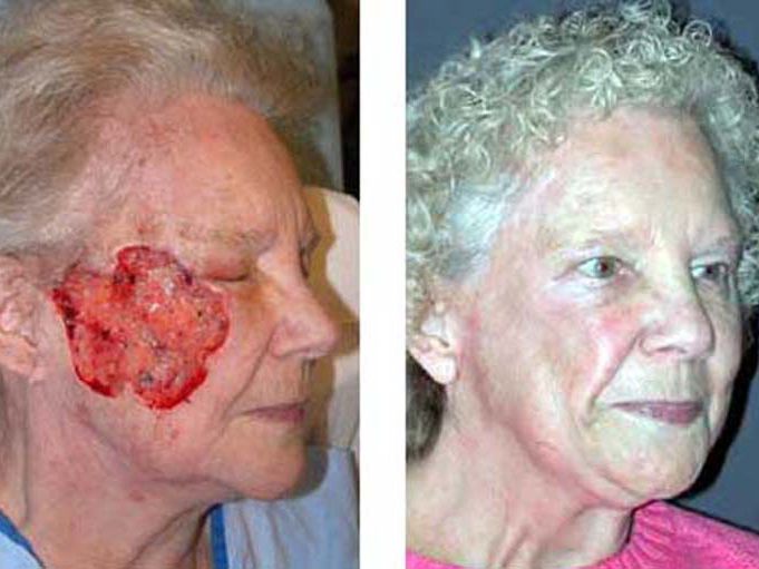Basal Cell Carcinoma Removal On Face