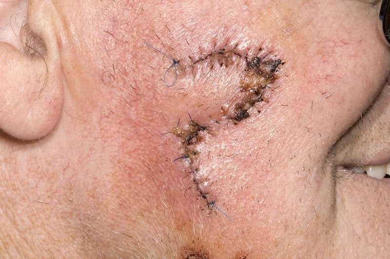 Basal cell carcinoma scar