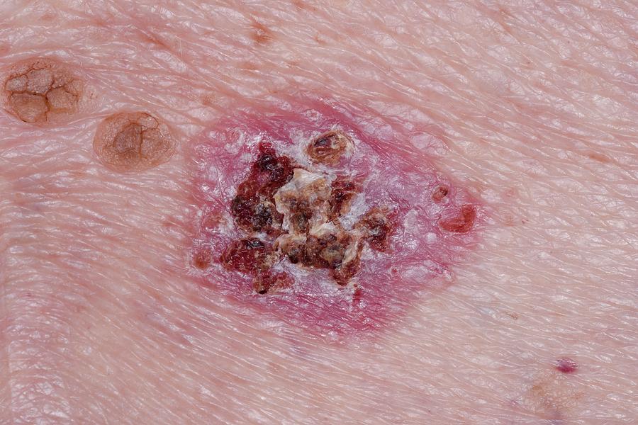 Basal Cell Carcinoma Skin Cancer Photograph by Dr P ...