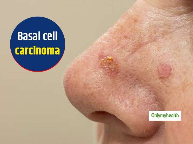 Basal Cell Carcinoma: Symptoms, Causes And Treatment By Oncologist Dr ...