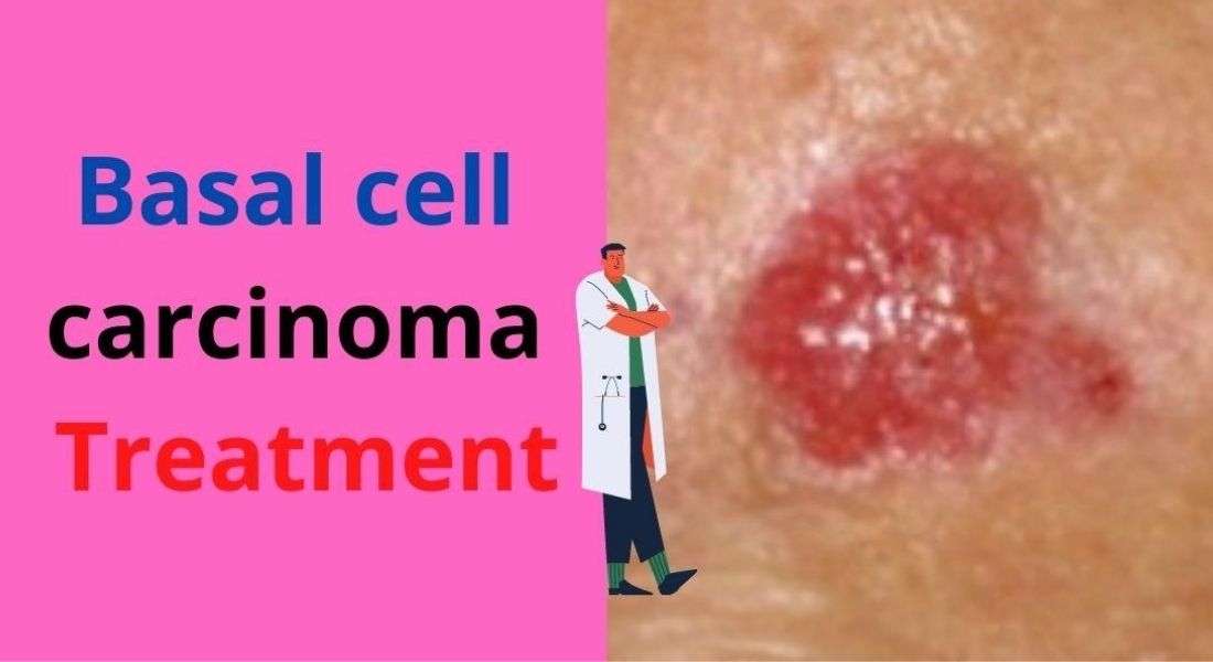 Basal cell carcinoma Treatment and causes