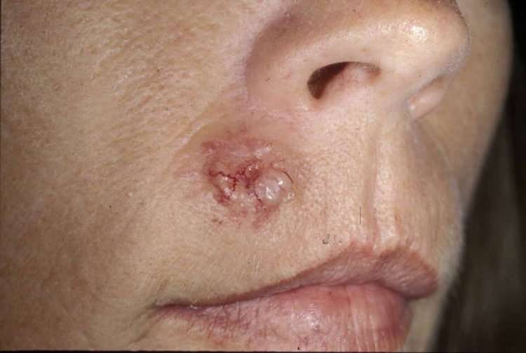 Basal Cell Carcinoma Treatment