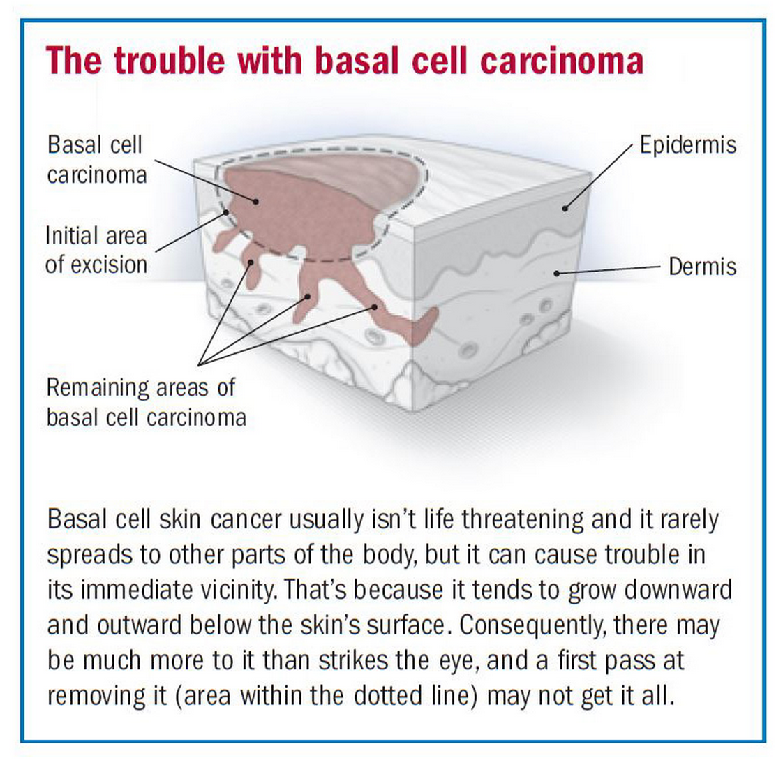 Basal Cell Carcinoma Utah County