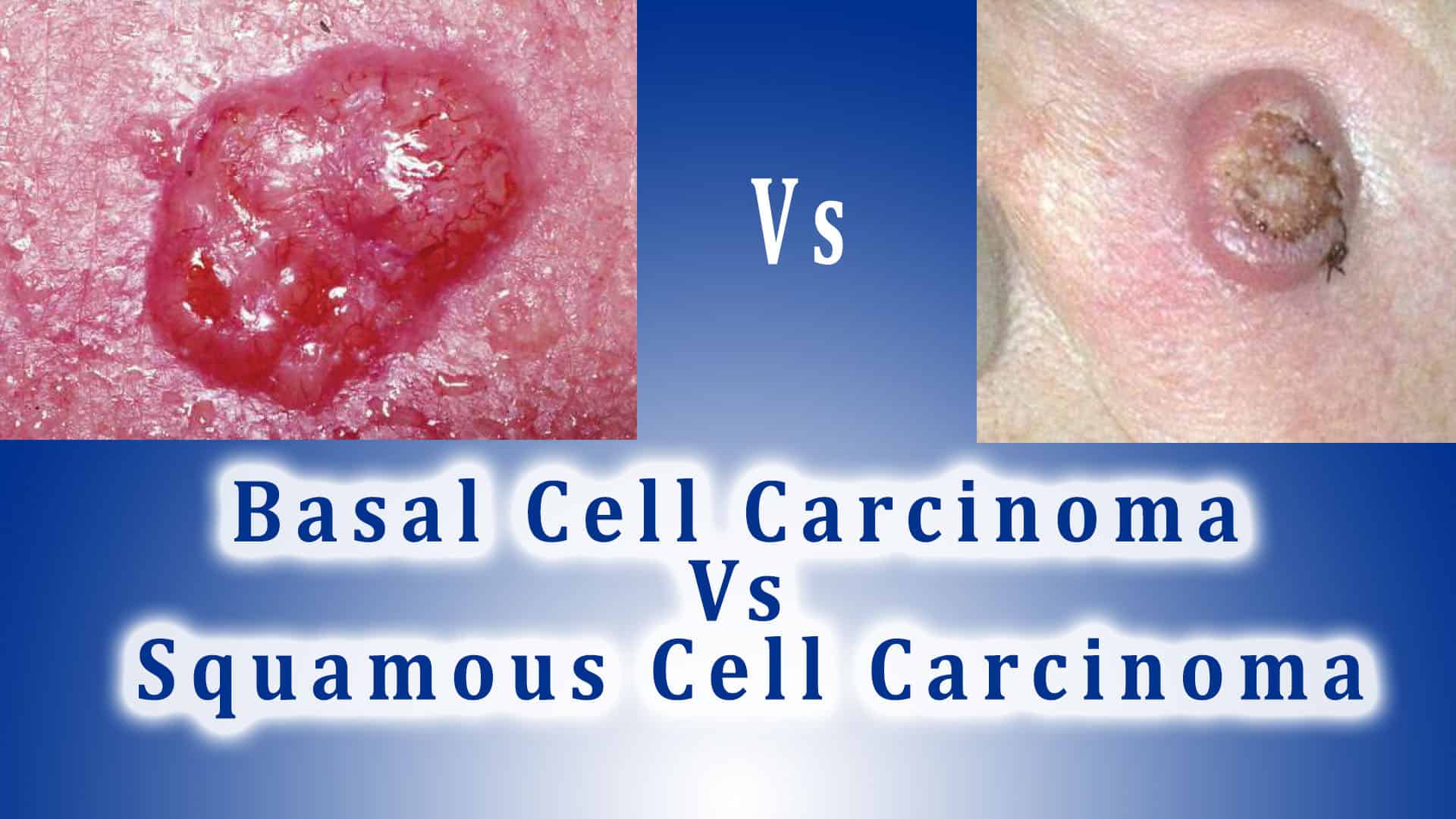 Basal Cell Carcinoma Vs Squamous Cell Carcinoma (BCC Vs SCC)