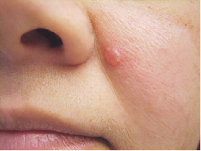 Basal Cell Carcinoma Warning Signs and Images