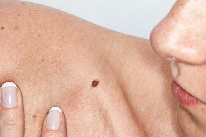 Basal Cell Carcinoma: What is it? Why Grow? Symptoms ...