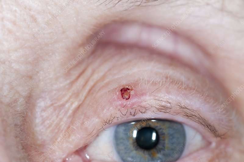 Basal cell skin cancer on the eyelid