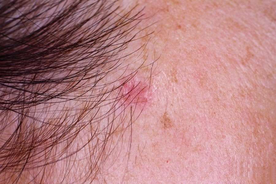 BCC (Basal Cell Carcinoma)