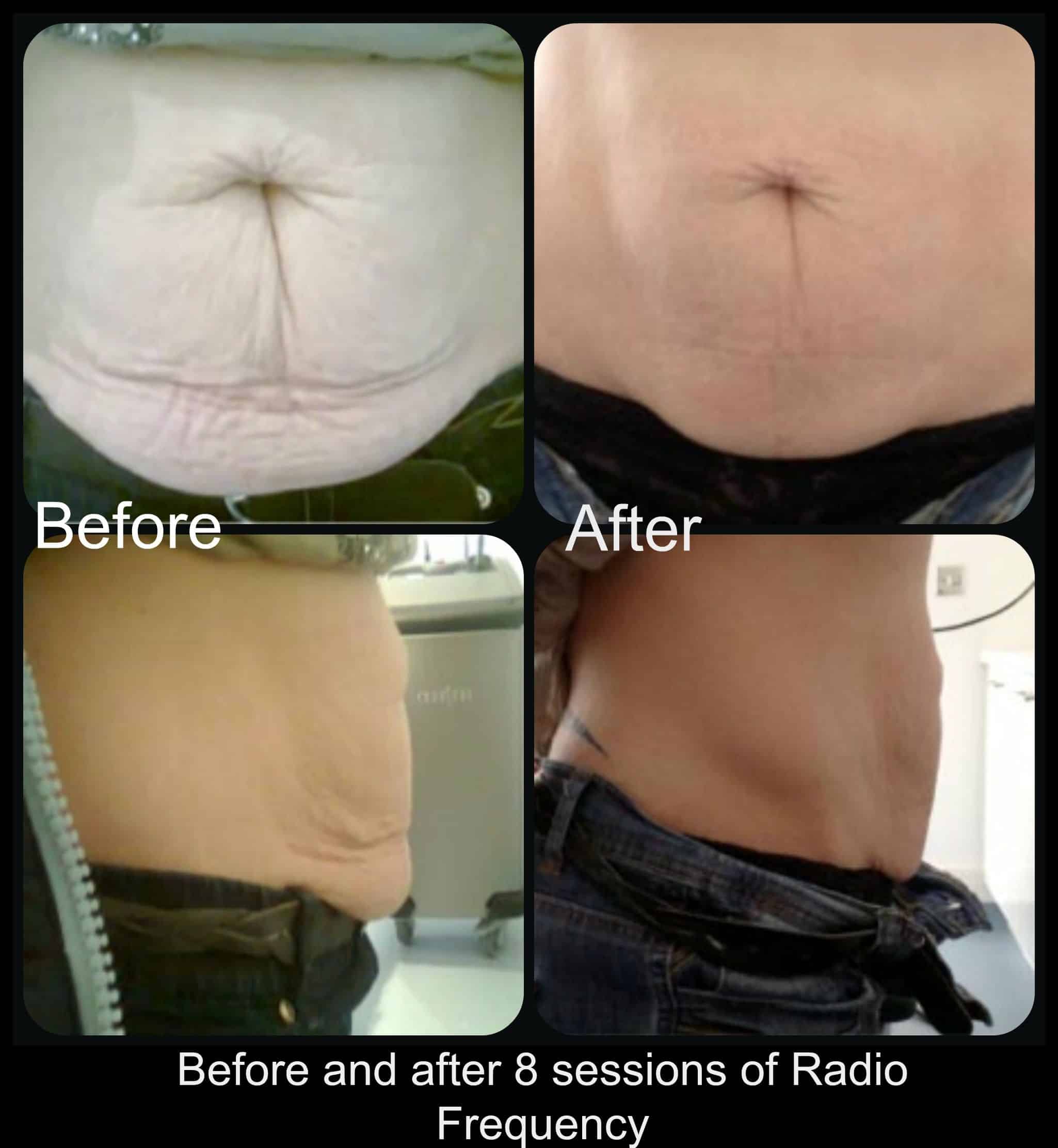 Before and after 8 sessions of Radio Frequency
