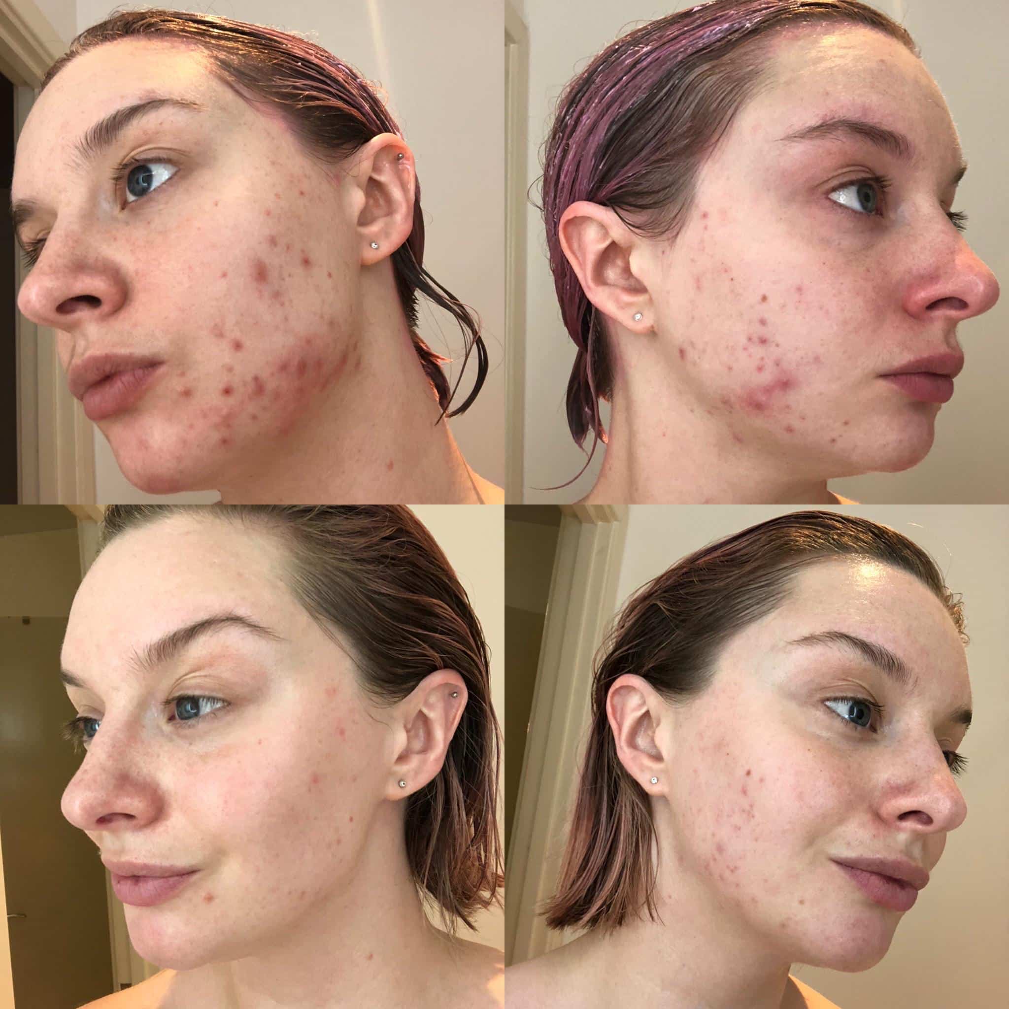 Before &  Now: 3 months, Yasmin, Epiduo &  Azaelic Acid 10% : acne