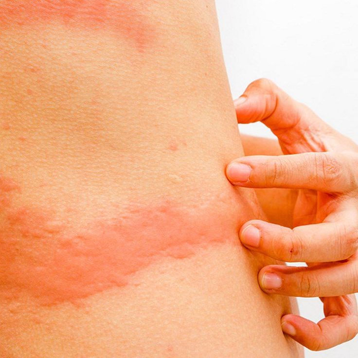 Best 25+ Skin rash types ideas on Pinterest