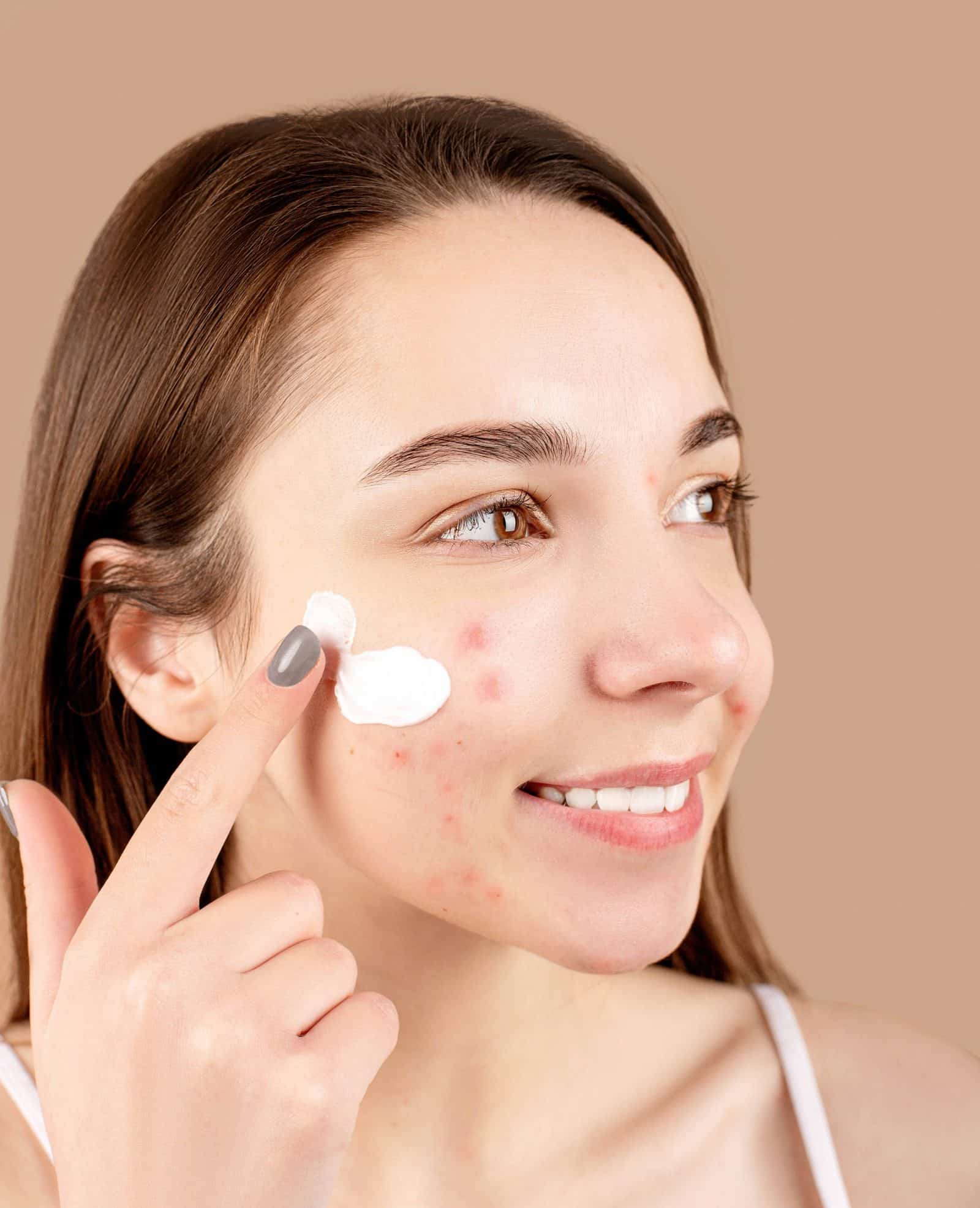 Best Acne Products For Sensitive Skin · Care to Beauty