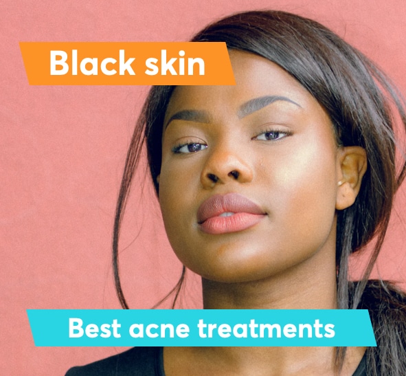 Best acne treatment for black skin