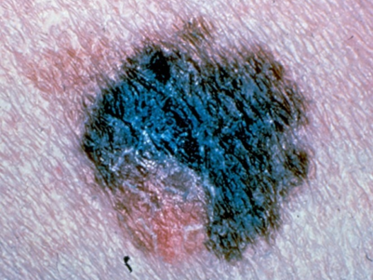 Beware: All are at risk for skin cancer