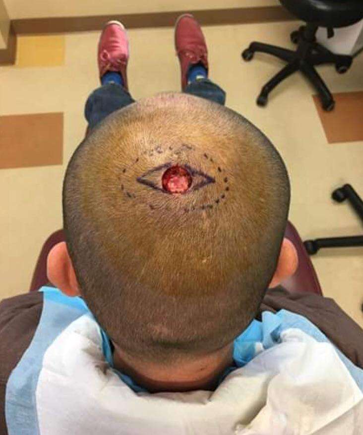 BF had to get a piece of skin cancer cut out : HadToHurt