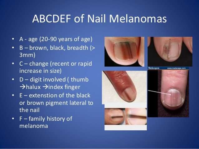 Big Toenail Has Vertical Light Brown Line: Melanoma?  Scary Symptoms