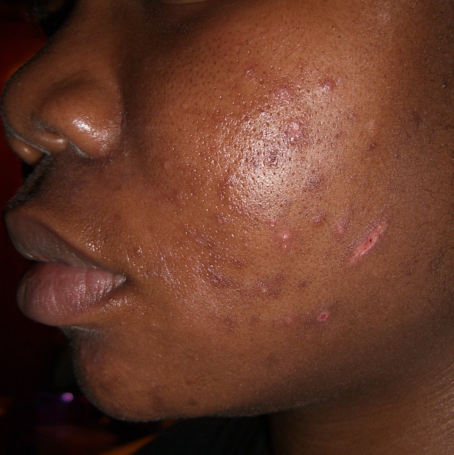 black rash on skin