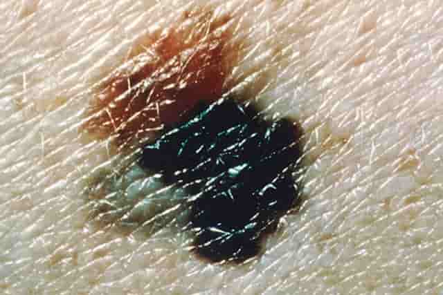 Black Spots on Skin, Dots, Patches, Dark, Tiny, Itchy, Pictures, Causes ...