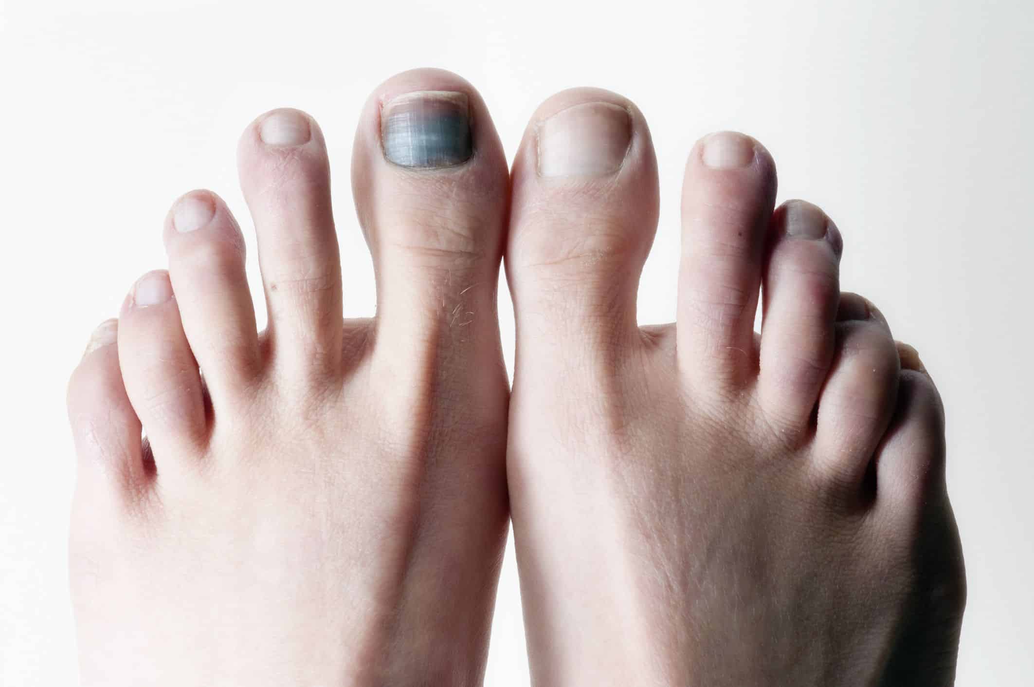 Black Toenail Cancer: Things You Must Know