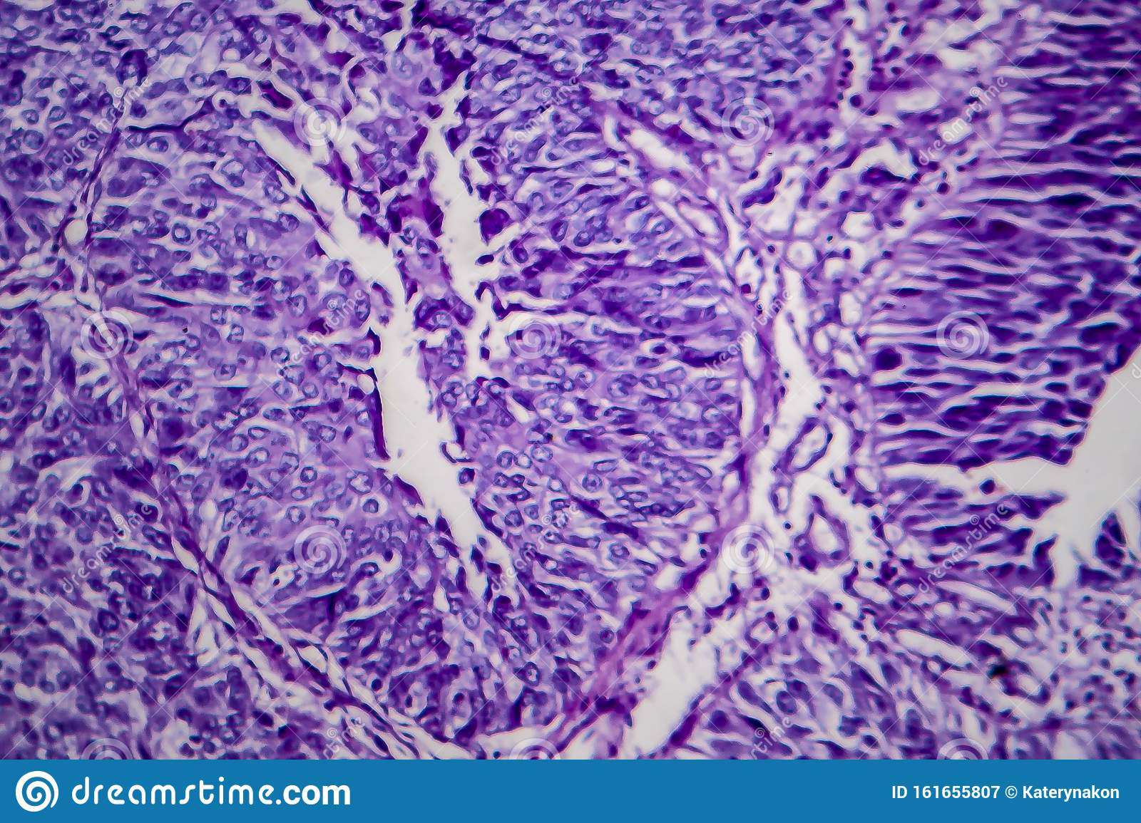 Bladder Transitional Cell Carcinoma, Light Micrograph ...