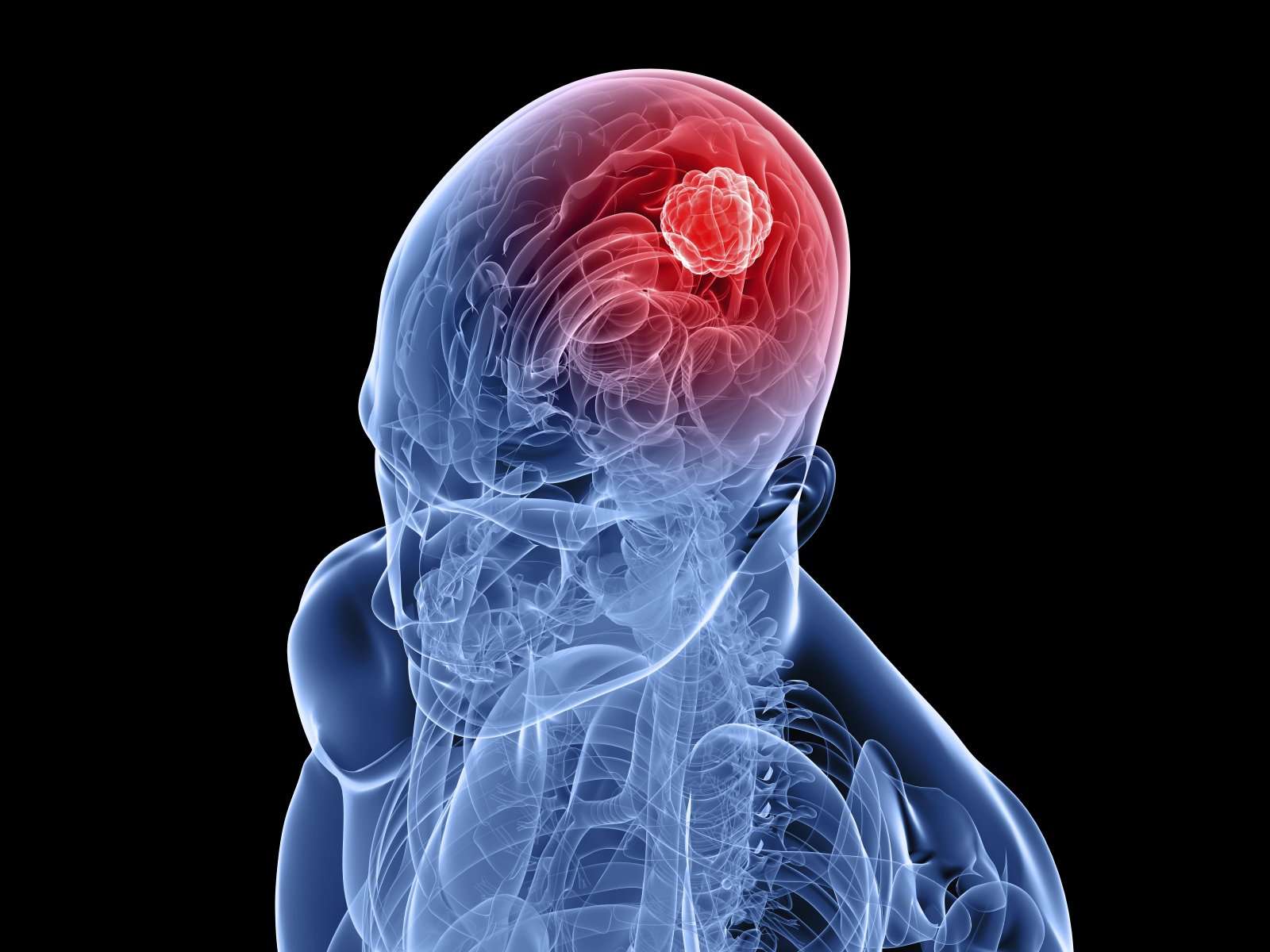 Brain Tumor. Causes, symptoms, treatment Brain Tumor