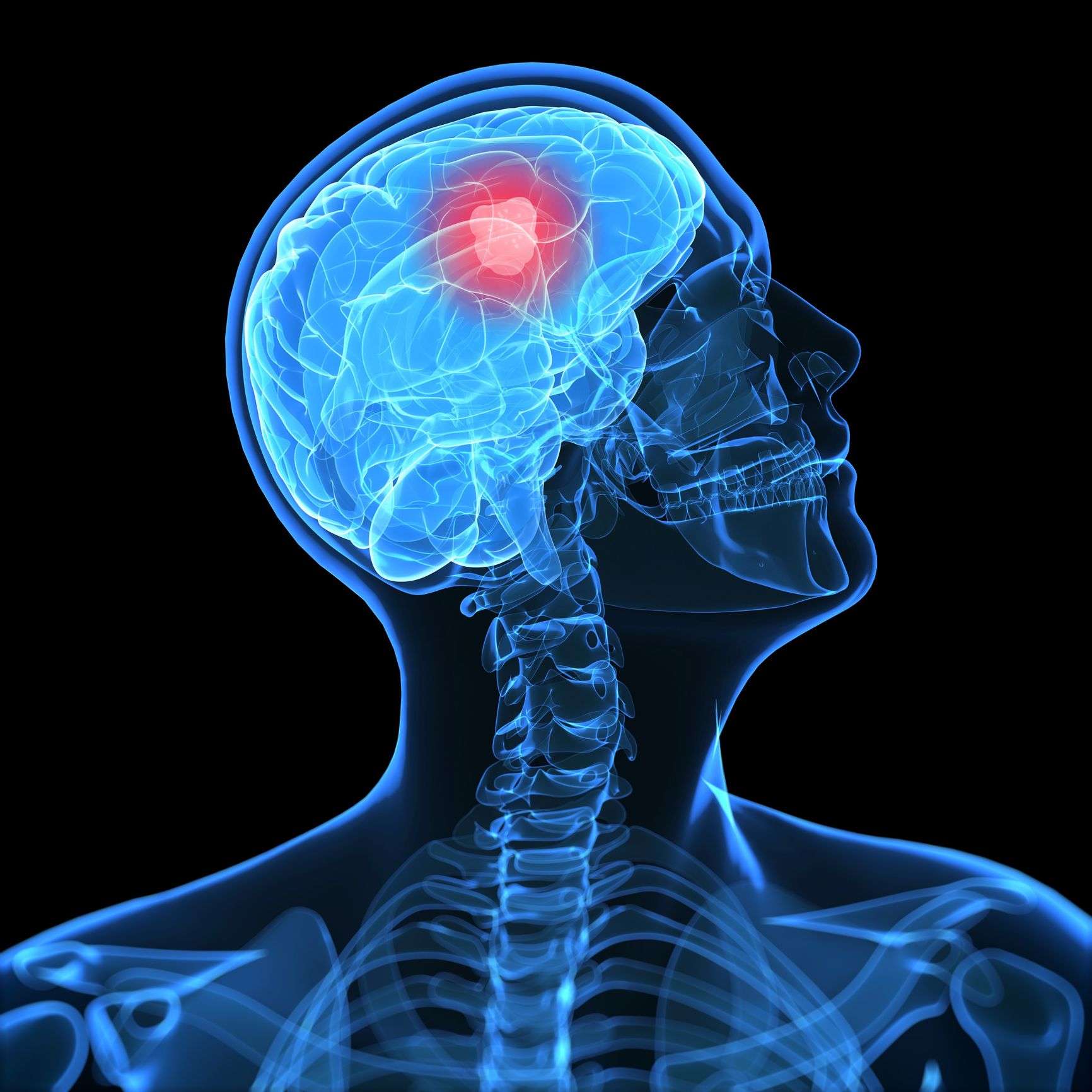 Brain Tumors: Overview and More