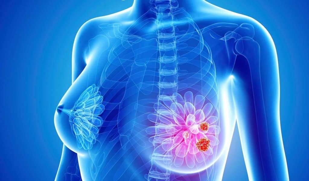 Breast Cancer Treatment. From Herbs to Modern Methods