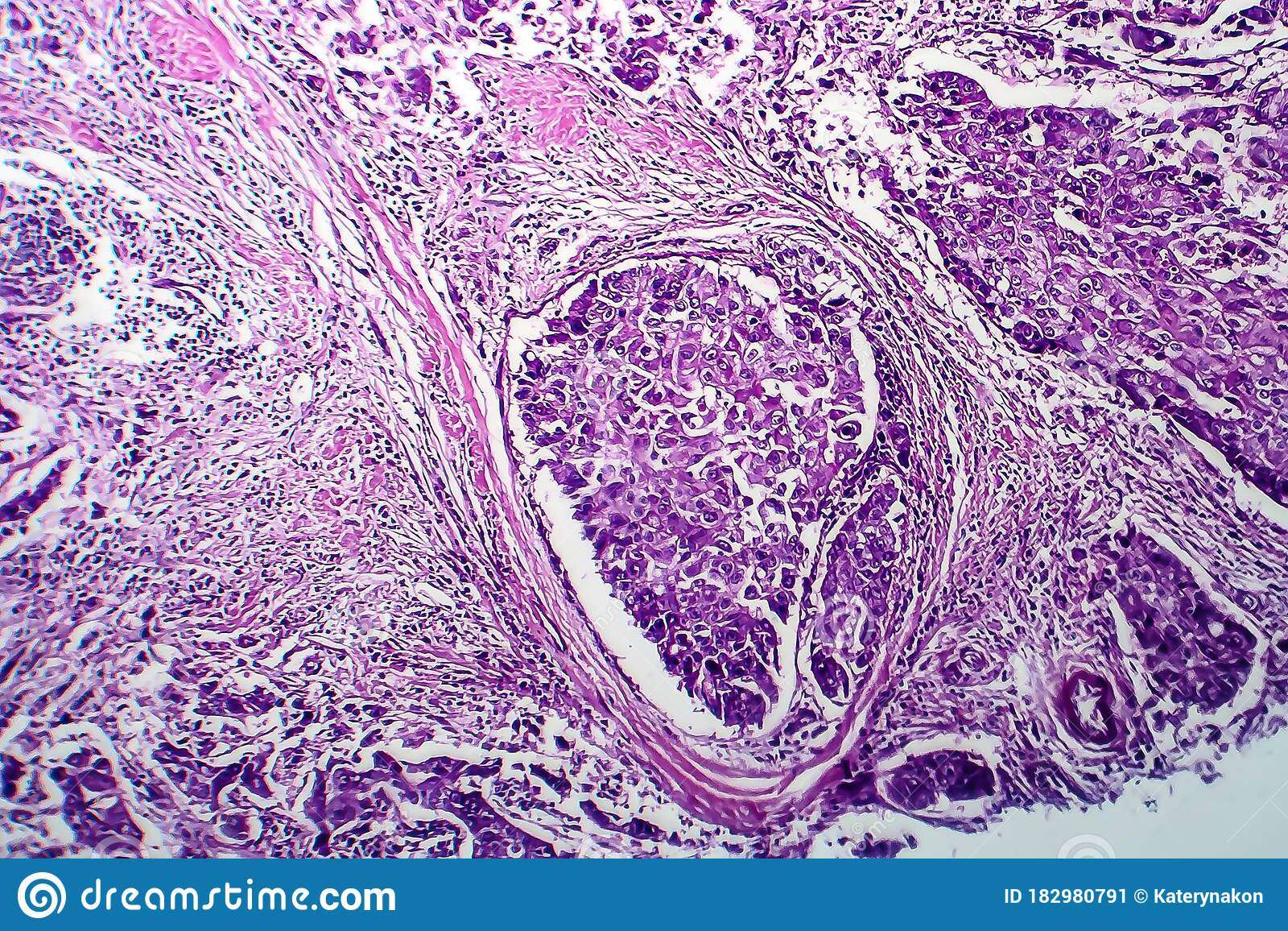 Breast Ductal Carcinoma, Light Micrograph Stock Image ...