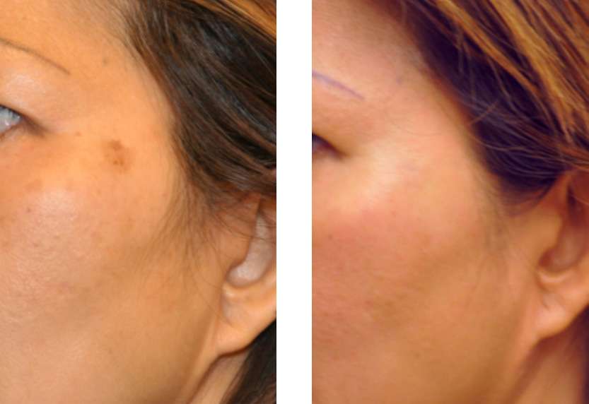 Brown spots, age spots and tattoo removal
