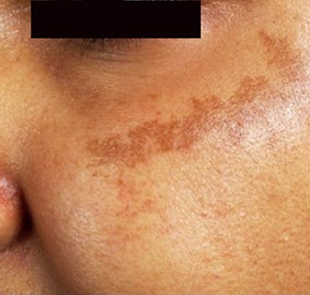 brown spots appearing on skin