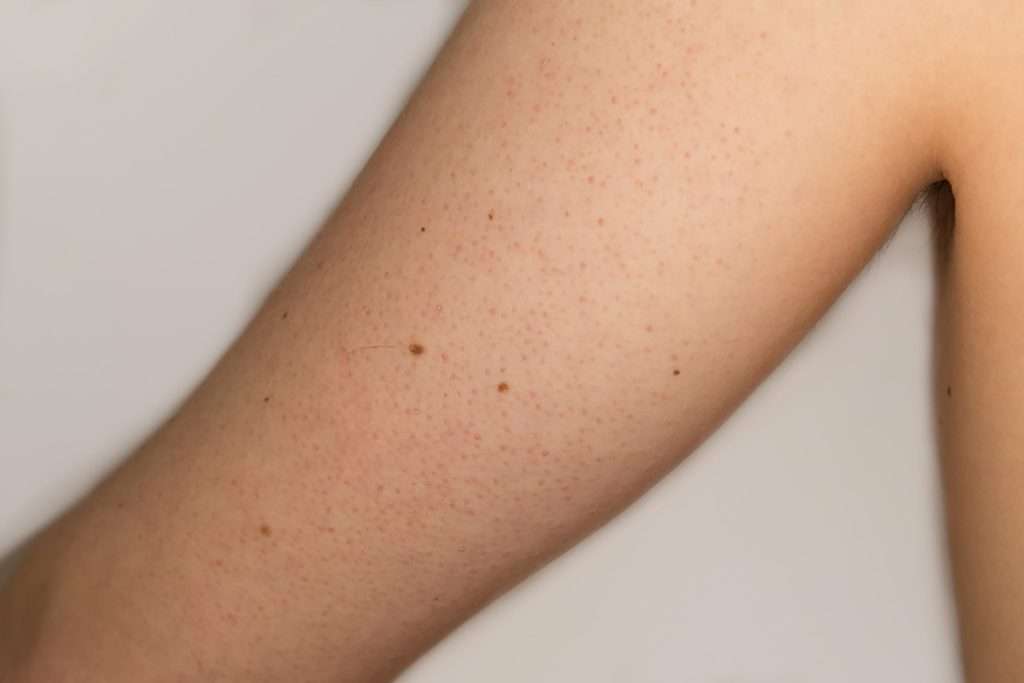 Bumps on Skin: Skin Mysteries Explained