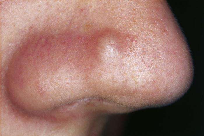 Bumps on the skin: Pictures, causes, and treatments