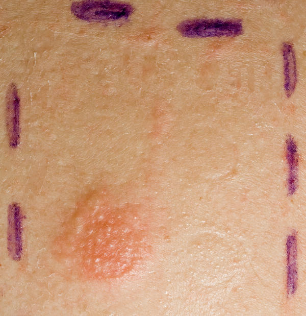 Bumpy Patches on Skin