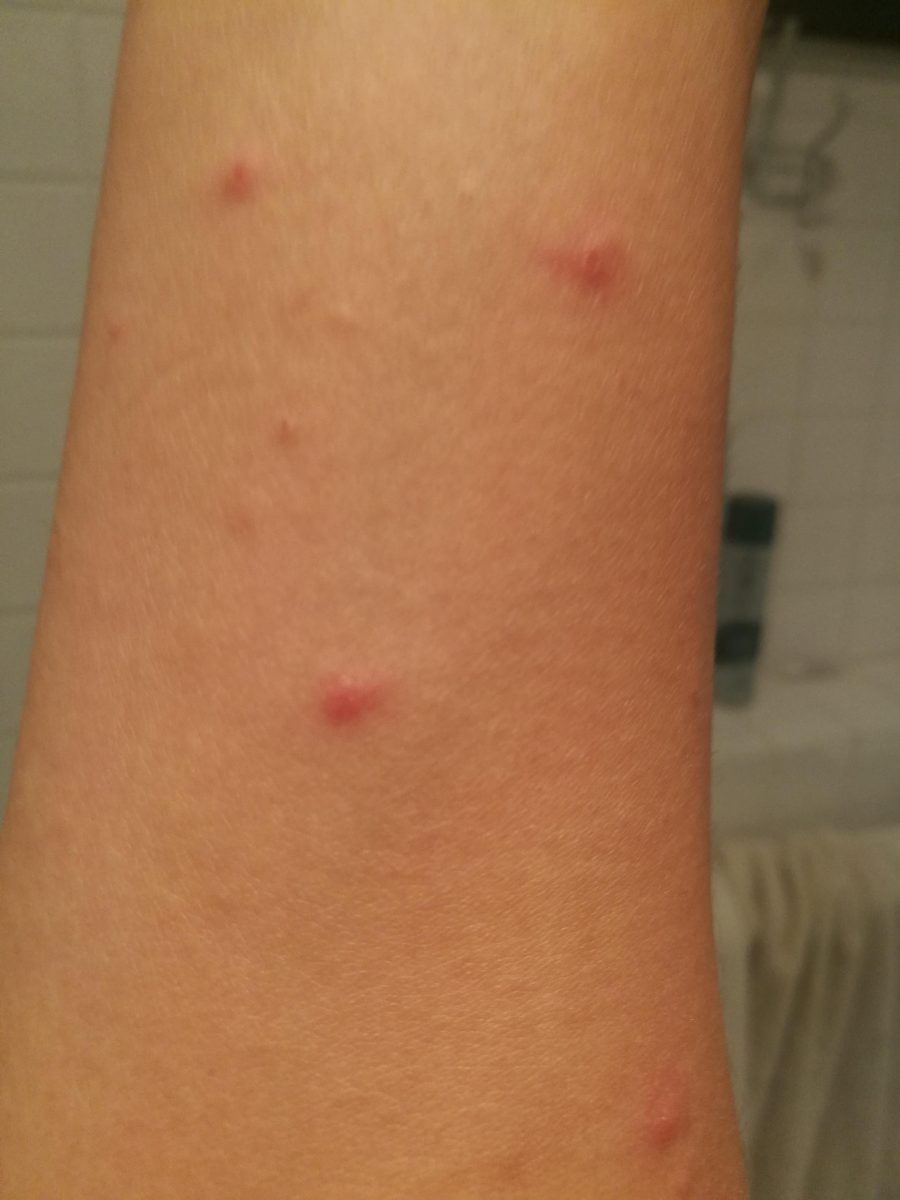 Came back from camping and got these itchy bumps across my body. Anyone ...