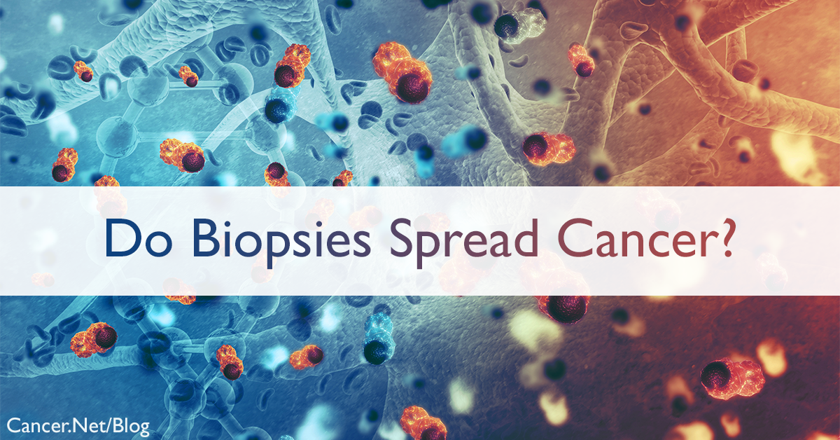 Can a Biopsy Make My Cancer Spread?