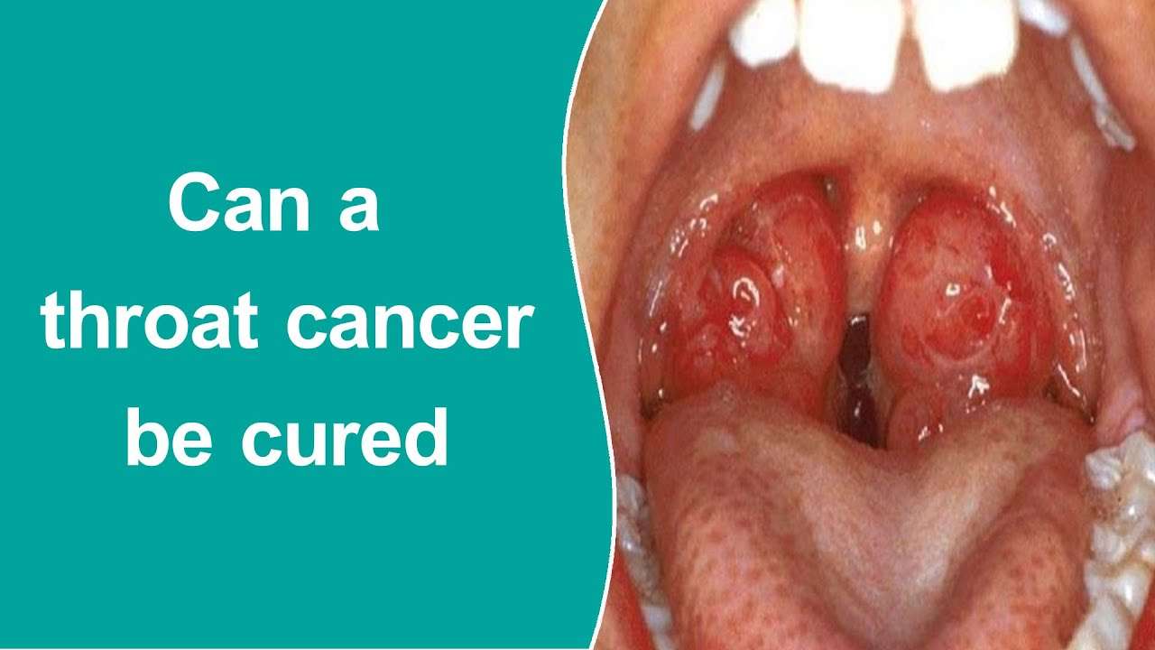 Can a throat cancer be cured?
