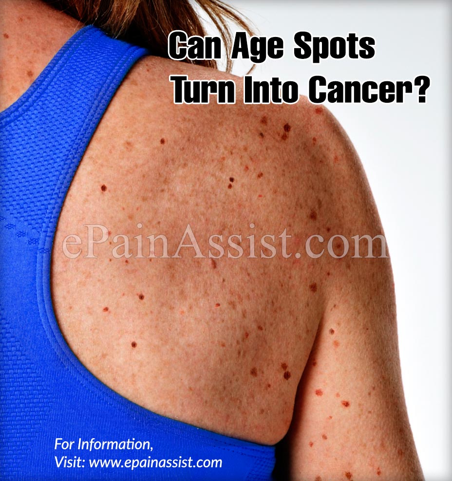 Can Age Spots turn into Cancer?