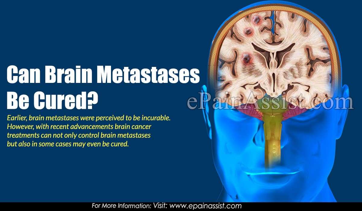 Can Brain Metastases Be Cured?