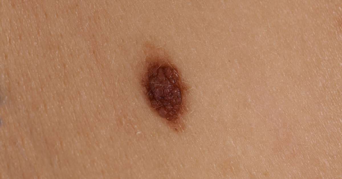Can Melanoma Cancer Come Back?  Health Essentials from ...