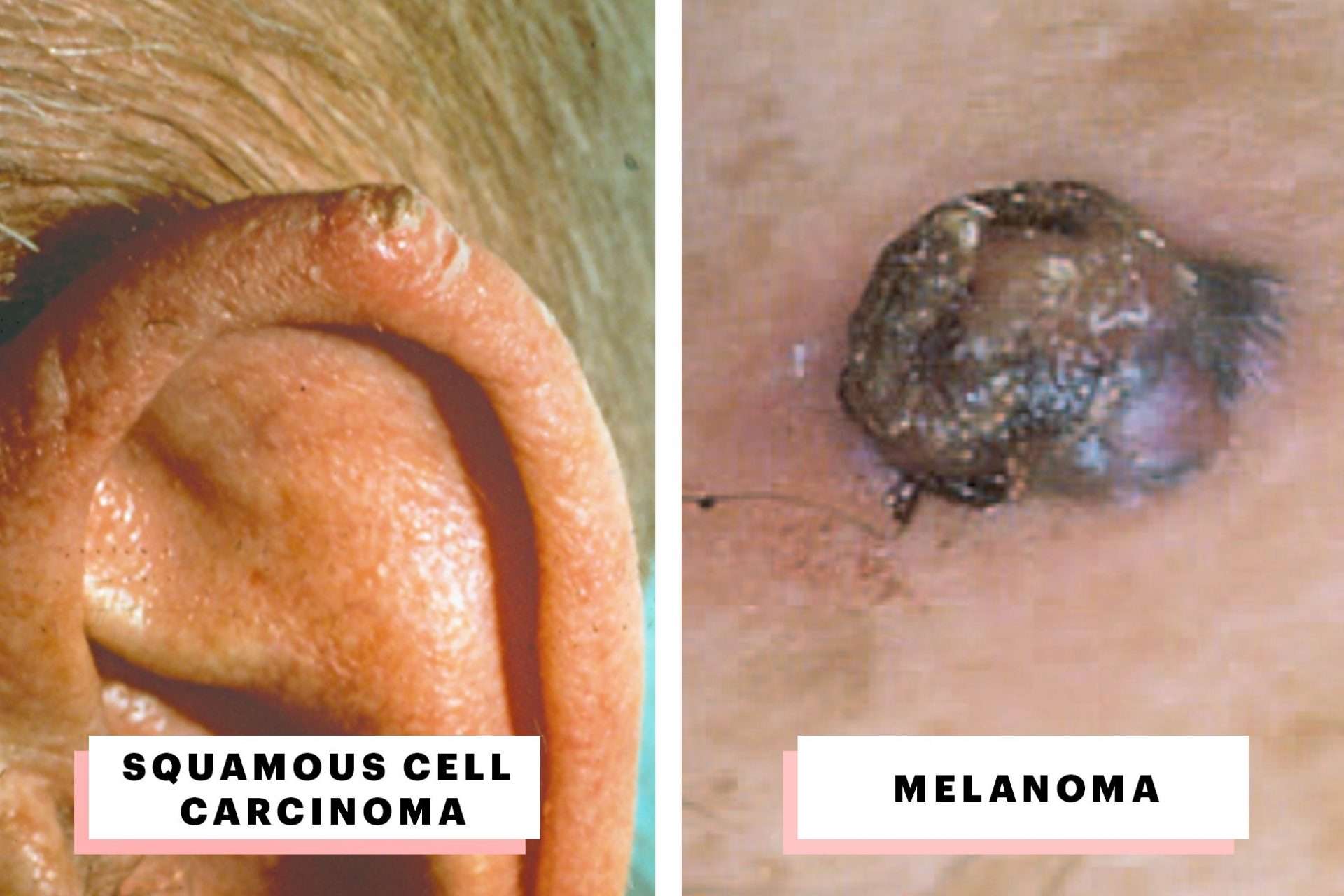 Can Melanoma Skin Cancer Kill You
