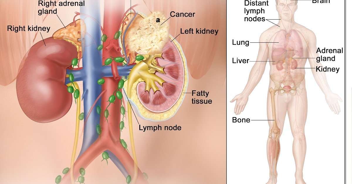 Can Metastatic Renal Cell Carcinoma Be Cured