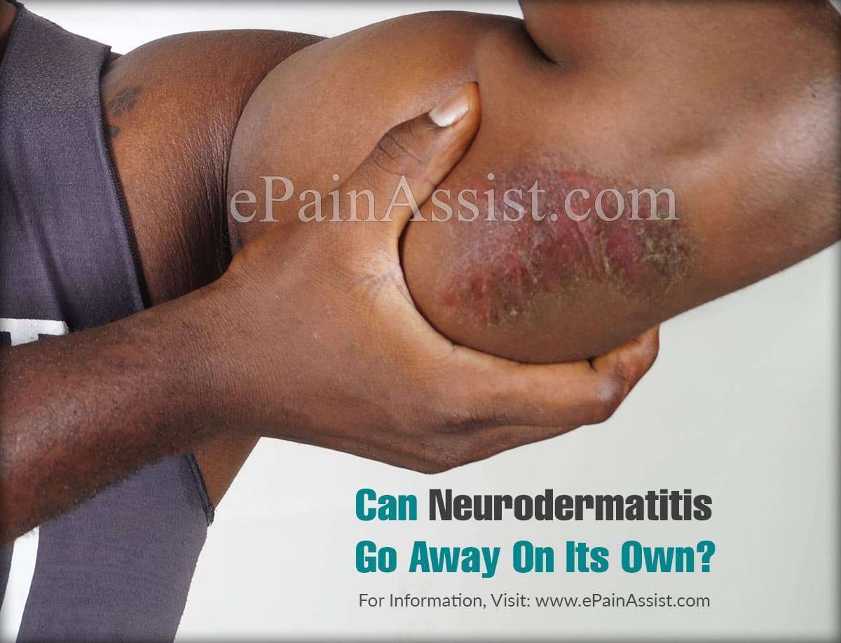 Can Neurodermatitis Go Away On Its Own &  How Do I Know If I Have It?