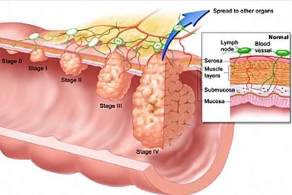 Can someone help me understand stage 4 colon cancer better ...