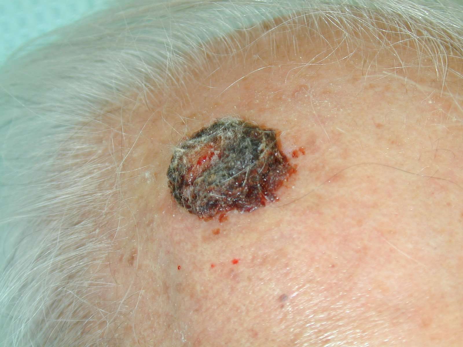 Can Squamous Cell Skin Cancer Be Fatal